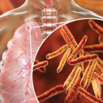 तनहुँमा १८३ क्षयरोगी उपचारको दायरामा