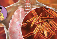 तनहुँमा १८३ क्षयरोगी उपचारको दायरामा